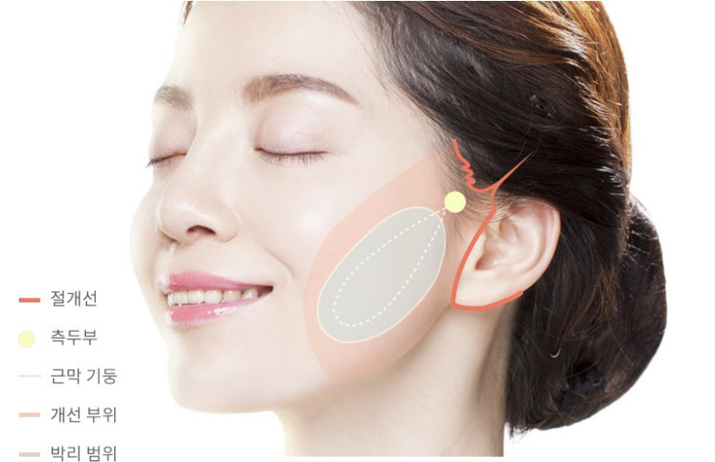 안면거상방법 여자 사진